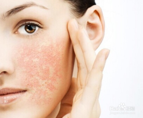 Natural Anti-allergic Plant Extracts In Cosmetics